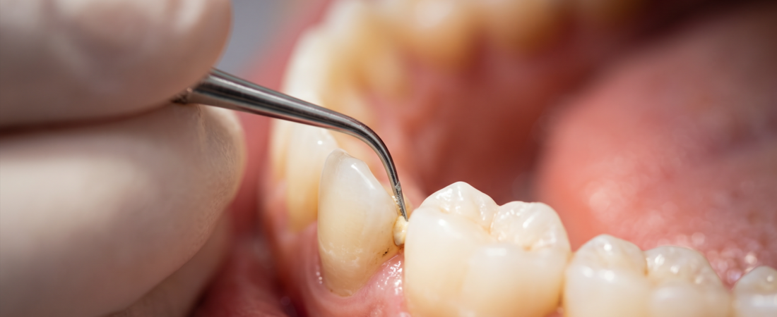 Limpieza Dental Profesional: Las 6 razones por las que tu sonrisa la necesita (y cada cuánto hacerla)